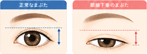 正常なまぶたと眼瞼下垂のまぶたの比較図