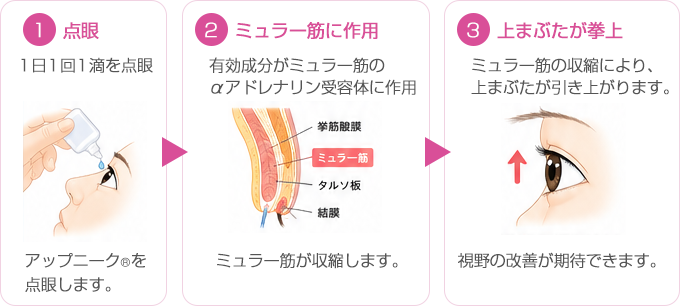 点眼による治療の流れの図